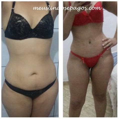 Enxerto De Gordura No Glúteo Antes E Depois - Enxerto De Gordura No Glúteo Fotos Antes E Depois - Livros