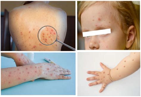 monkeypox infection   updated narrative review focusing