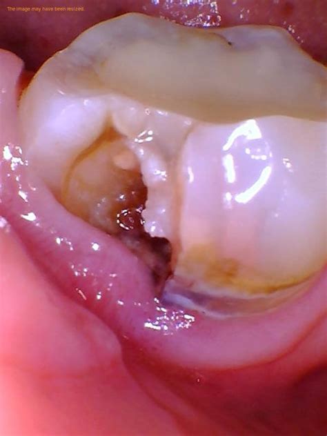 how to kill a tooth nerve at home