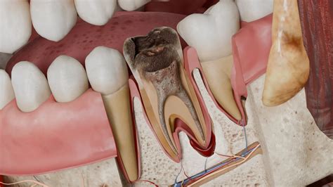 condensing osteitis  symptoms  treatment