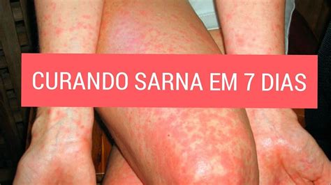O Que Cura Sarna Humana - Como curar sarna em 7 dias (escabiose) - YouTube