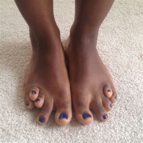 toe disorders atelier yuwaciaojp