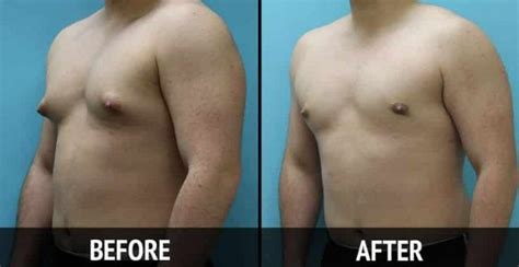 Gynecomastia Treatment: 8 Natural Options - Home Remedies