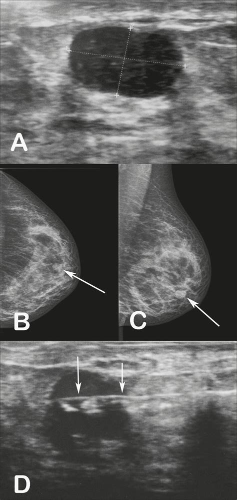 SciELO Brasil - Tubular adenoma of the breast: radiological and