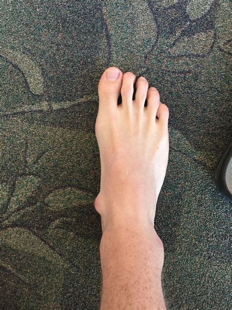 Hate to be a pop-tease, but this was a bone spur I had removed