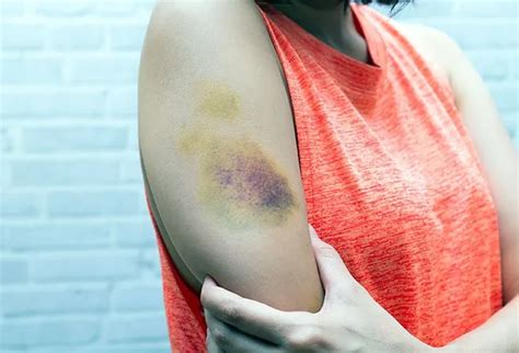 easy bruising  sign  okkiicom