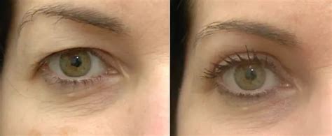 Non-Surgical Blepharoplasty London | Non Surgical Eye Lift