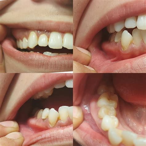 Hard, sore "ridge" growing along gums?? Unsure as to what that might be