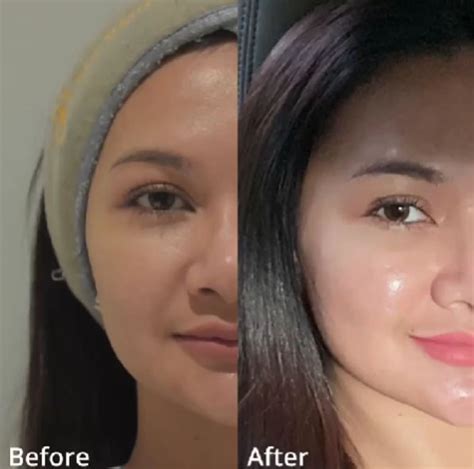skin booster solusi rejuvenasi regenerasi kulit