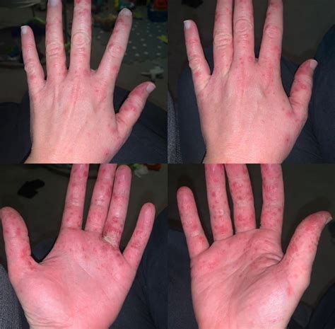 hfm  dyshidrosis comparison rdyshidrosis