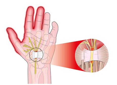 carpal tunnel syndrome  pain relief clinic