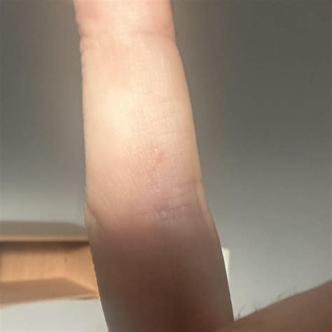 Active scabies burrows? : r/scabies