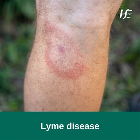 lyme disease tick bite rash