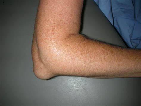 Elbow (Olecranon) Bursitis - OrthoInfo - AAOS