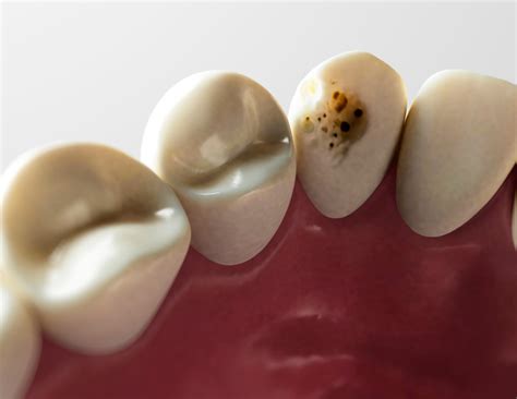 reverse tooth decay  early cavities