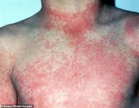 brain bleeding virus cases surge     cdc warns  urgent