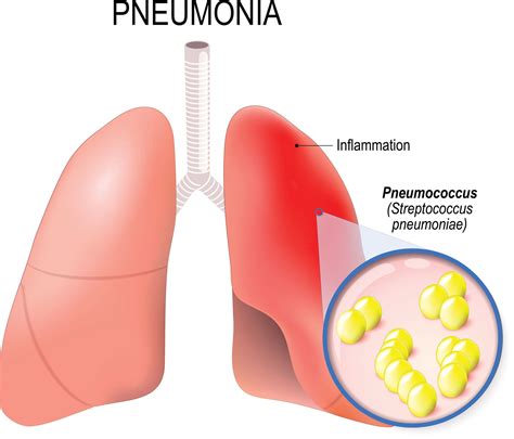 Atypical Pneumonia Rash
