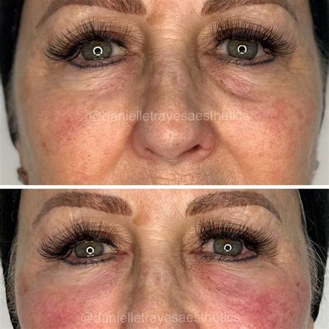 Eye Treatments - Rejuvenate Laser & Skin Clinic