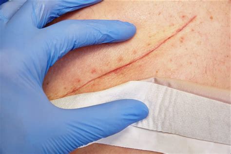 wound care queensland skin cancer clinic