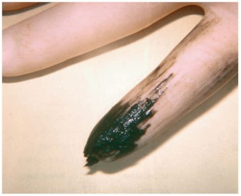 Blood In Stool Melena of all time The ultimate guide | stoolz