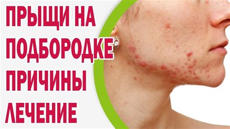 Почему появляются прыщи на подбородке - YouTube