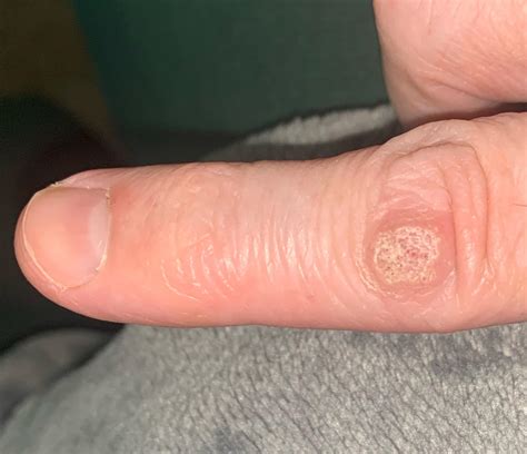First cryo.. only wart I have.. stubborn one? : r/Warts