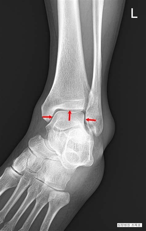 발목의 만성 염좌 및 연골 손상에서의 관절경적 미세천공술 및 활액막 절제술(arthroscopic microfracture ...