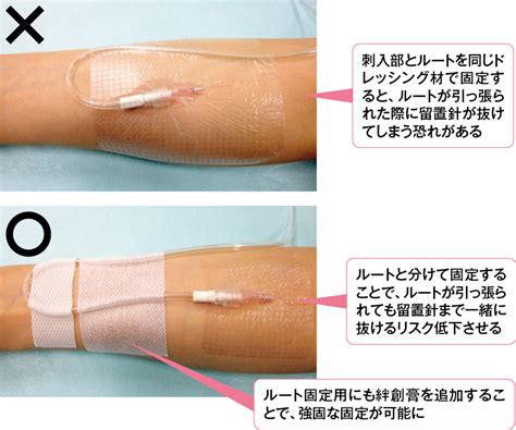 末梢静脈カテーテルの固定方法のポイント | エキスパートナースweb