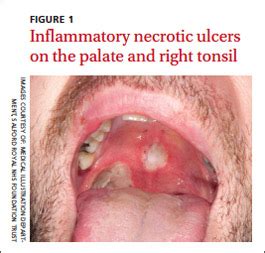 Ulcer On Tonsil