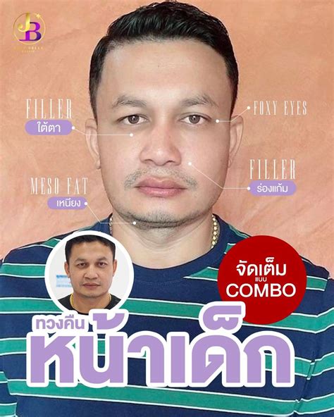 Filler Restylane Vital Light 1 cc -บริเวณใบหน้า - SkinX แอปหาแพทย์ ...