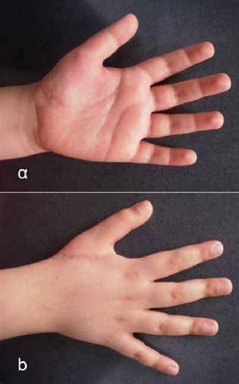 pictures    hand  thenar eminence sixteen months