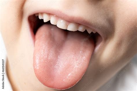 tongue    year  healthy child papillae   tongue