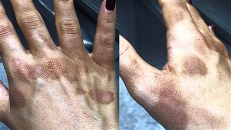 Mancha Na Mão Escura - Manchas Amarelas Na Palma Da Mão - REVOEDUCA