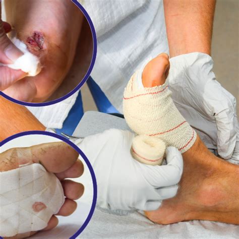 diabetic foot ulcer stages  symptoms treatment