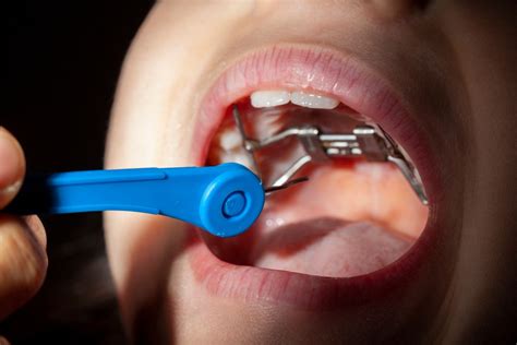 What Is a Palatal Expander and How Does it Work? - Precision ...