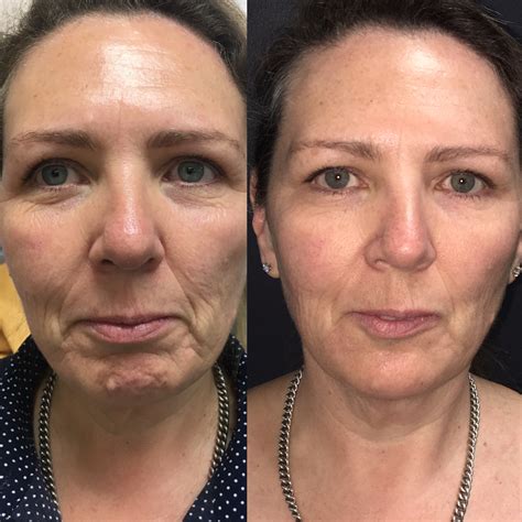 face lifting non surgical 6