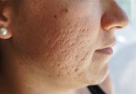 Acne scarring treatment – Acne Scars – Acne.org Forum