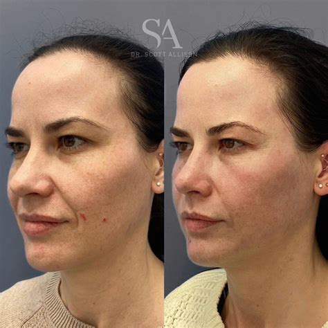 laser brisbane enhanced skin   months