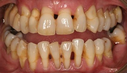 Phân biệt viêm nướu và viêm nha chu