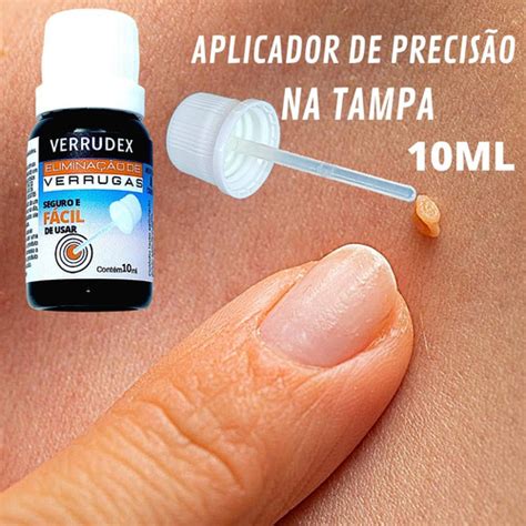 O Que E Bom Para Verruga