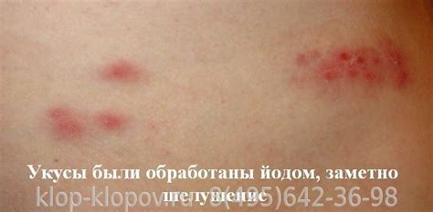 Укусы постельных клопов