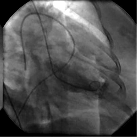 Use of the Impella 2.5 left ventricular assist device in a patient with