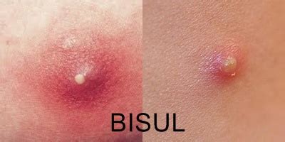 artikel kesehatan jenis bisul  membahayakan