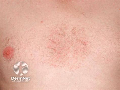 seborrhoeic dermatitis chest seborrhoeic eczema