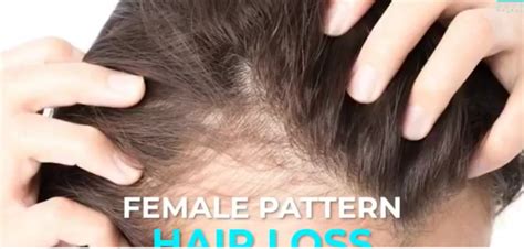 rambut mama gugur selepas bersalin  tip  nak atasi