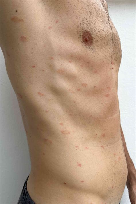 Pitiriasis Rosada Boda