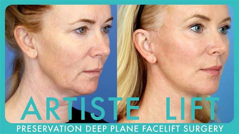 artiste lift  future  preservation deep plane facelift