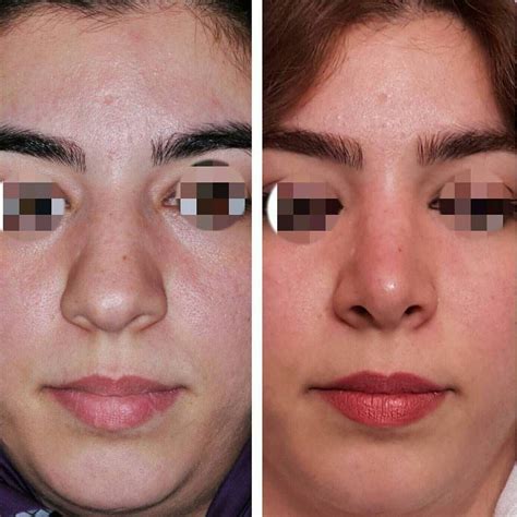 Incredible Liquid Rhinoplasty Before And After Bulbous Tip References ...