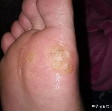 什么是跖疣，趾疣是什么，长了跖疣怎么办 - 知乎