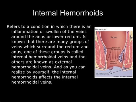 Hemorrhoids 1235093240420575 1